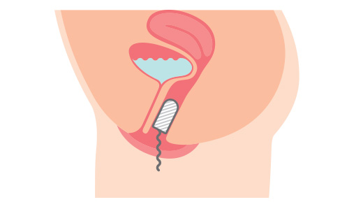 tampon-incontinencia-urinaria-mujeres