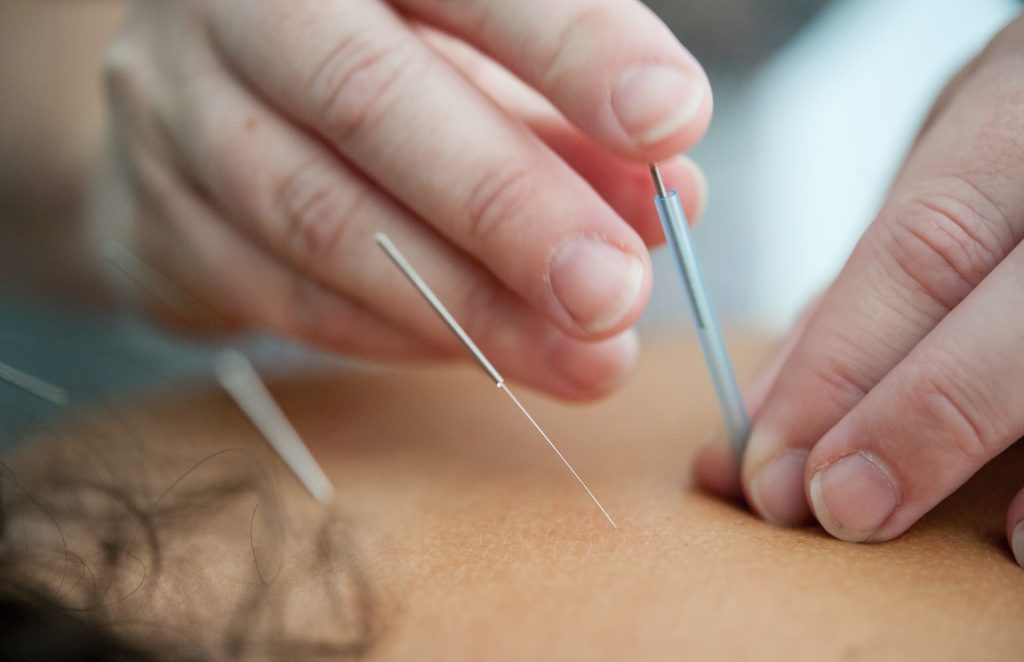 Las agujas de acupuntura con asas de la primavera - China Las agujas de  acupuntura esterilizadas, para un solo uso