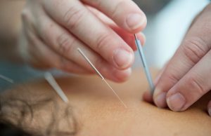 ¿Para qué sirven las agujas de acupuntura Conoce sus beneficios