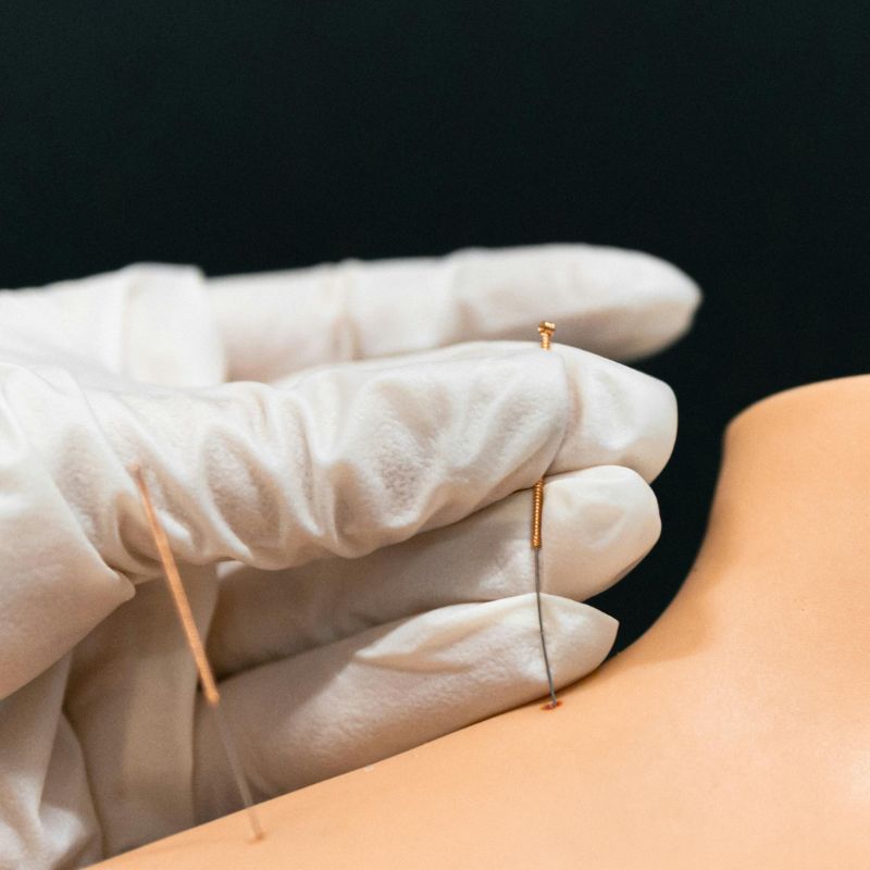 Acupuntura y Puncion Seca